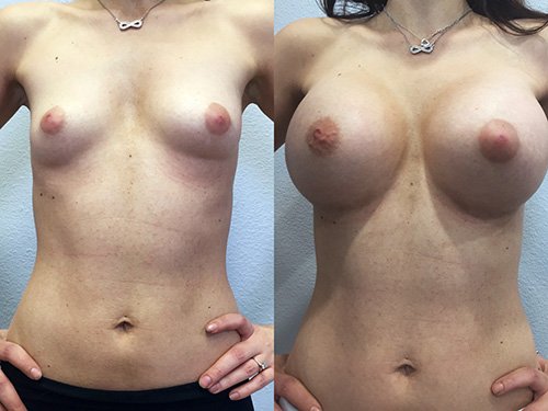 Breast Augmentation Case #1