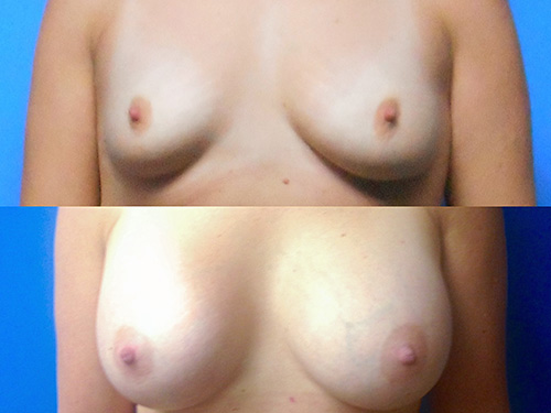 Breast Augmentation Case #2