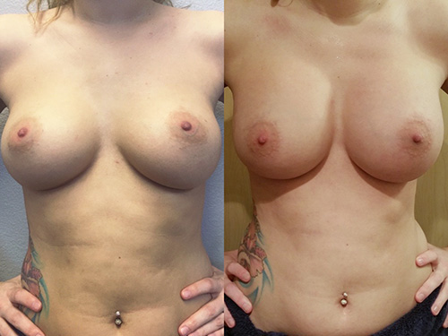 Breast Reaugmentation with Internal Restructuring Case 2