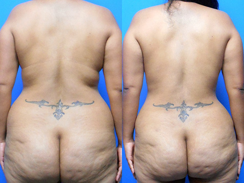 Liposuction of Back