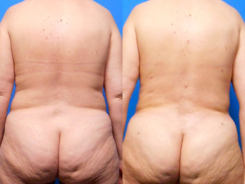 Liposuction of back flank and abdomen back view