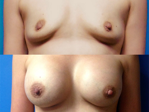 Breast Augmentation Case #5 - Front View