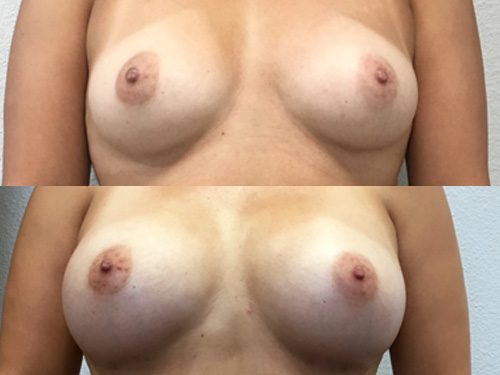Breast Augmentation Case #7