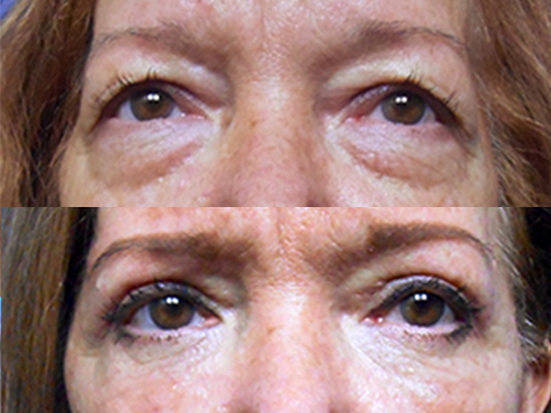 Upper and lower Blepharoplasty before and after thumbnail