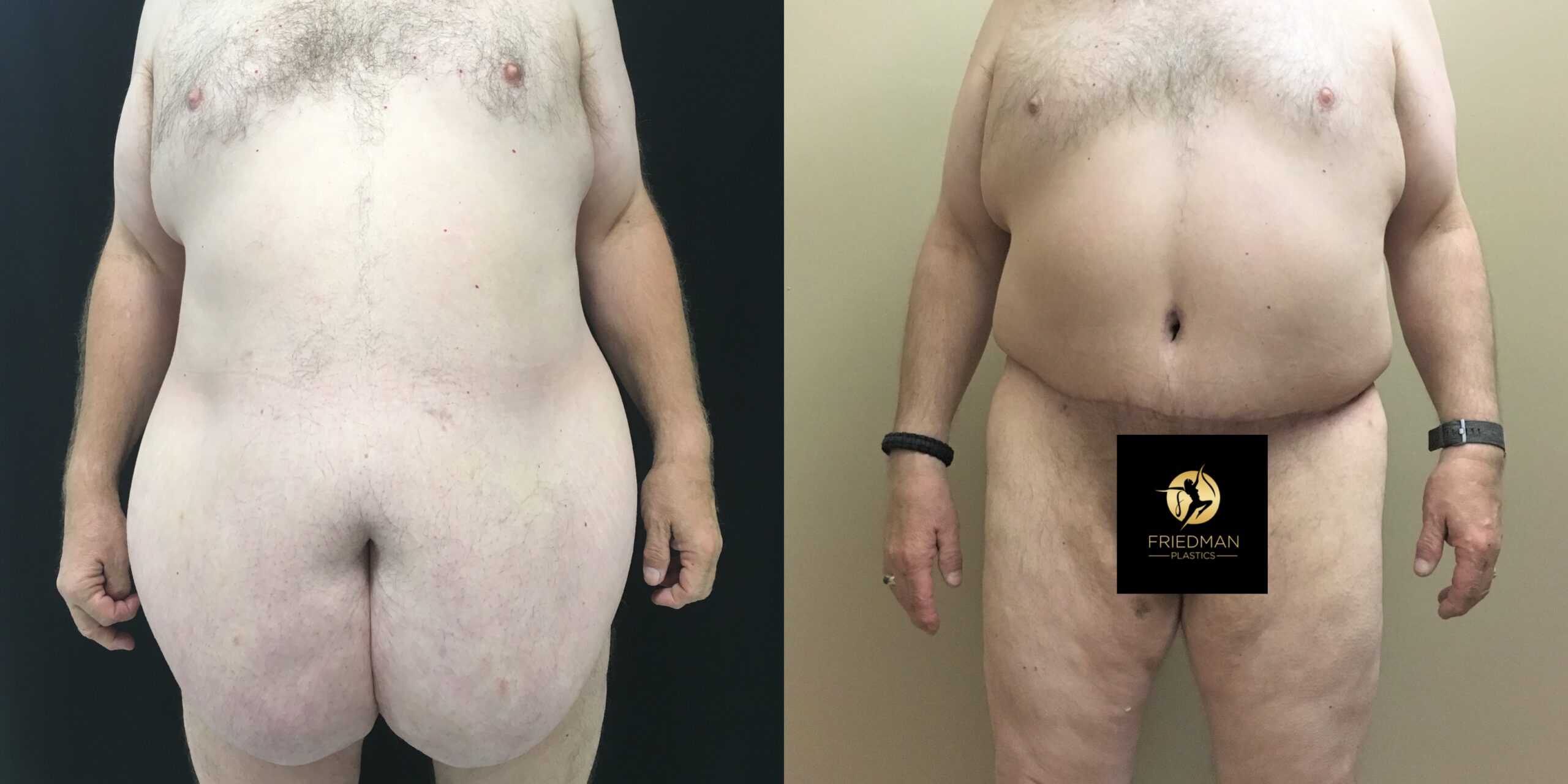 Abdominoplasty with Panniculectomy and Posterior Lower Body LiftLower Body Lift