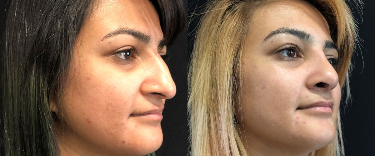 Female Rhinoplasty Before and After