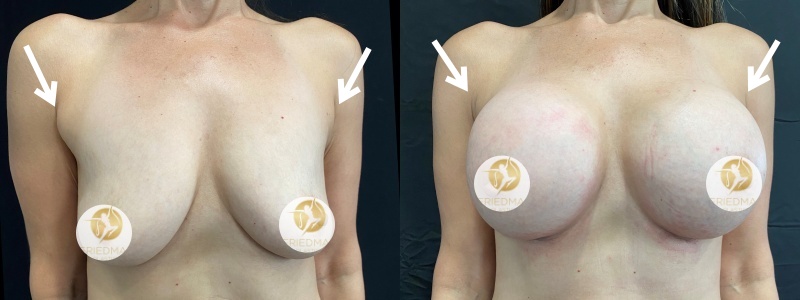 Breast Augmentation Case #10
