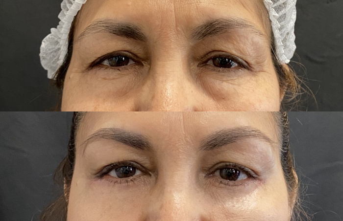 eyes and mid facelift