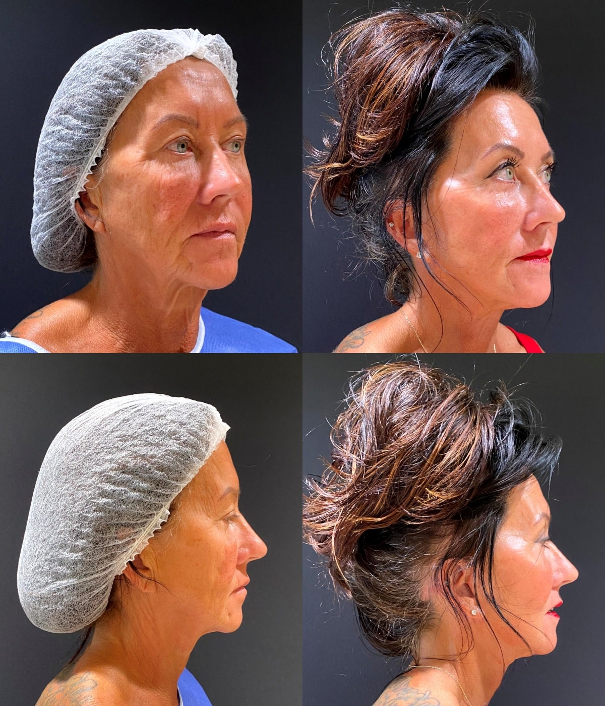 Before and After Image: Lower Face lift with Upper and Lower Blepharoplasty - front