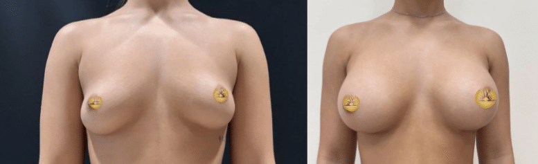 Before and After Image: Breast Augmentation/ 23 year old/ Mentor 355cc High Profile Extra Memory Gel Implants