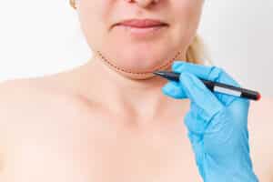 Woman with eyes closed, waiting as a plastic surgeon prepares to mark incision lines for chin reduction, augmentation, or double chin removal on a white background