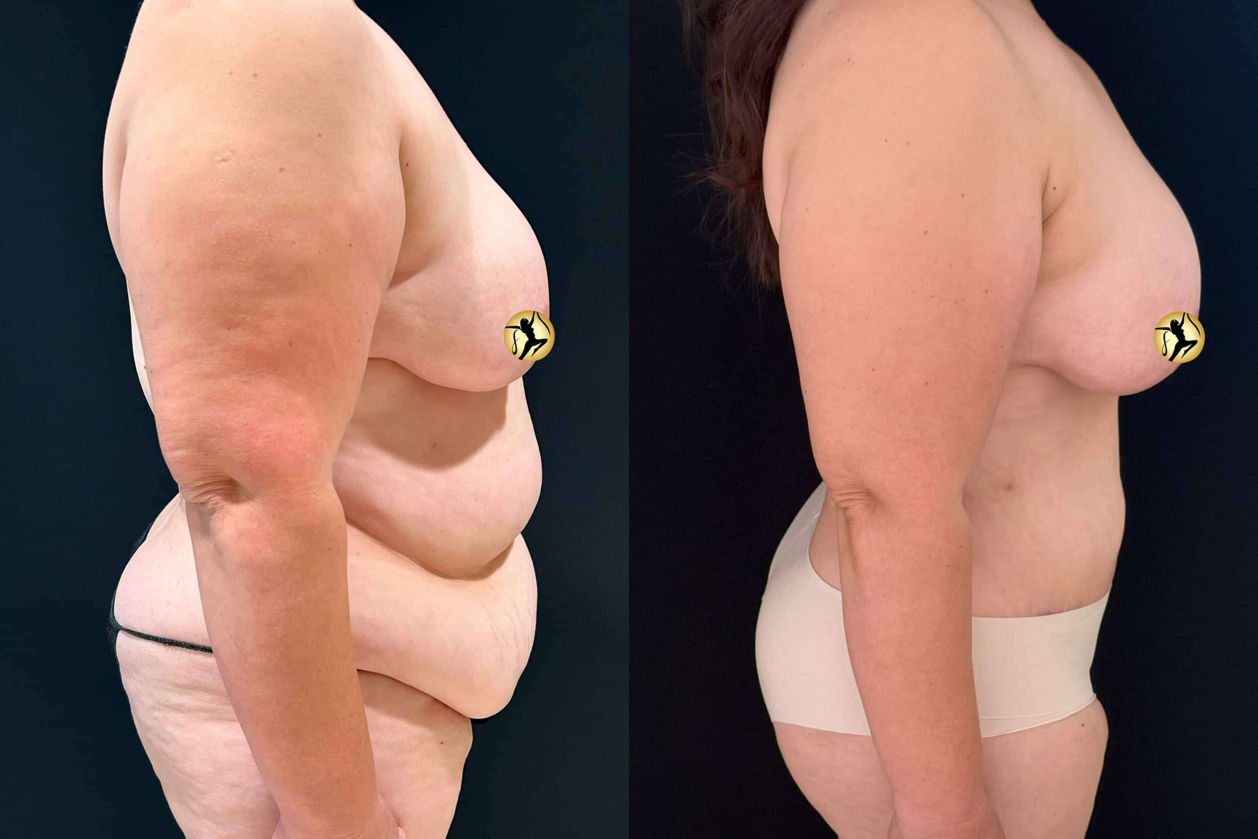 Before and After Image: Abdominoplasty and Liposuction - right-side