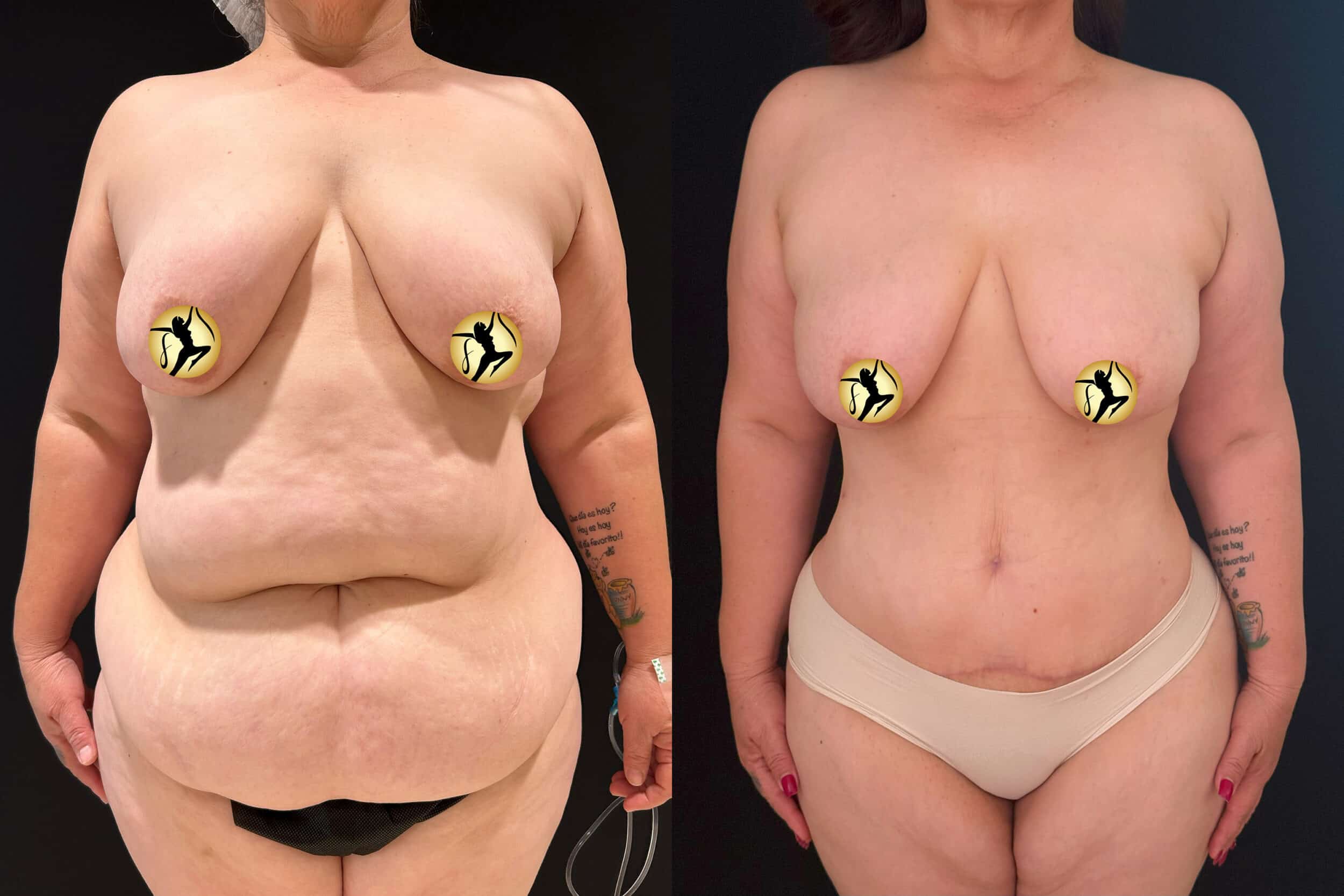 Before and After Image: Abdominoplasty and Liposuction - front