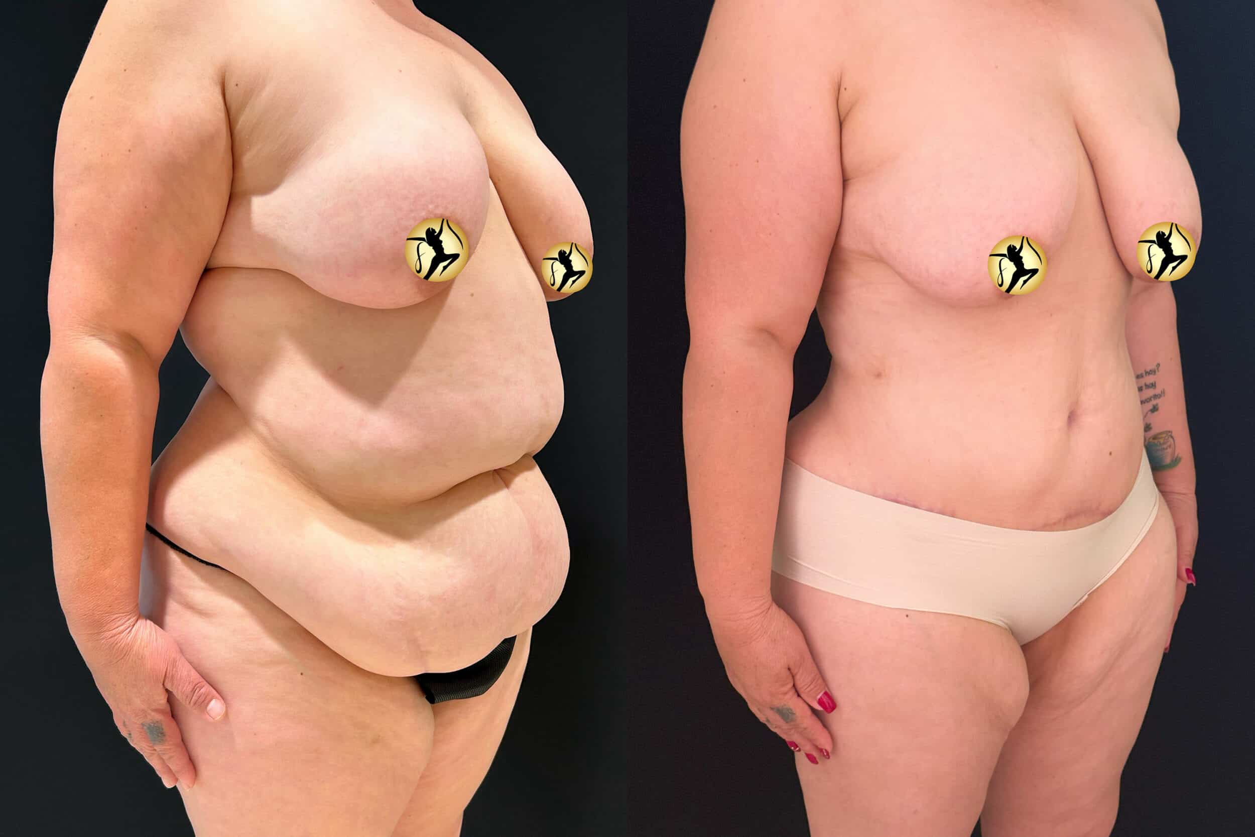 Before and After Image: Abdominoplasty and Liposuction - right-front-oblique