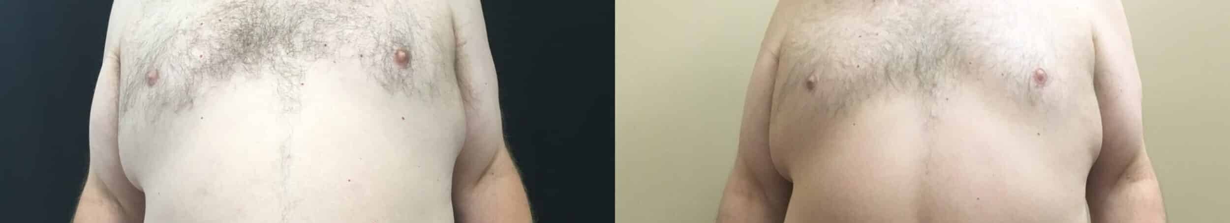 Before and After Image: Male Gynecomastia Reduction - front